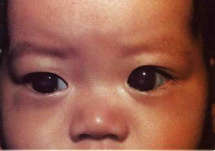 嬰幼兒性青光眼