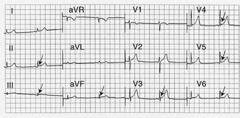 高鉀血癥心電圖 (43) 