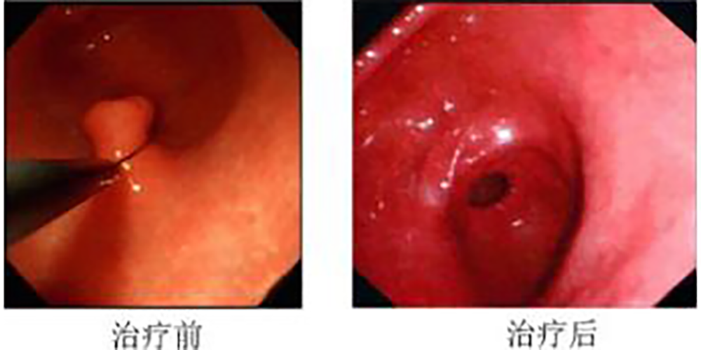 胃息肉治療前後