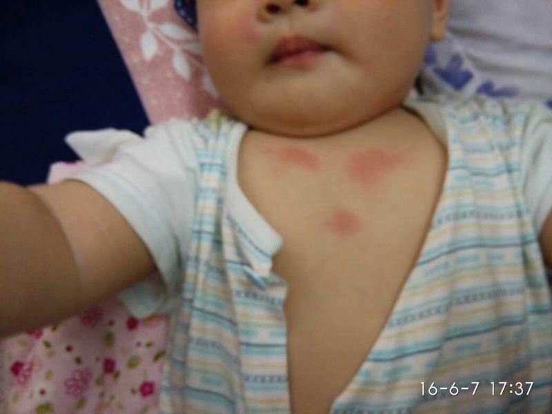 小兒症狀明顯流感