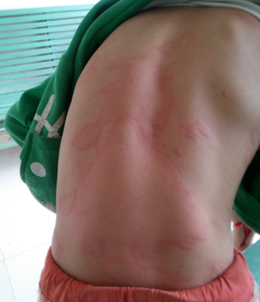 身體蟎蟲過敏症狀