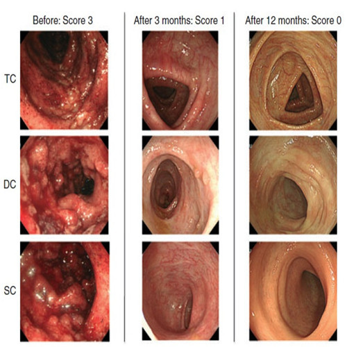 潰瘍性結腸炎手術前後複查