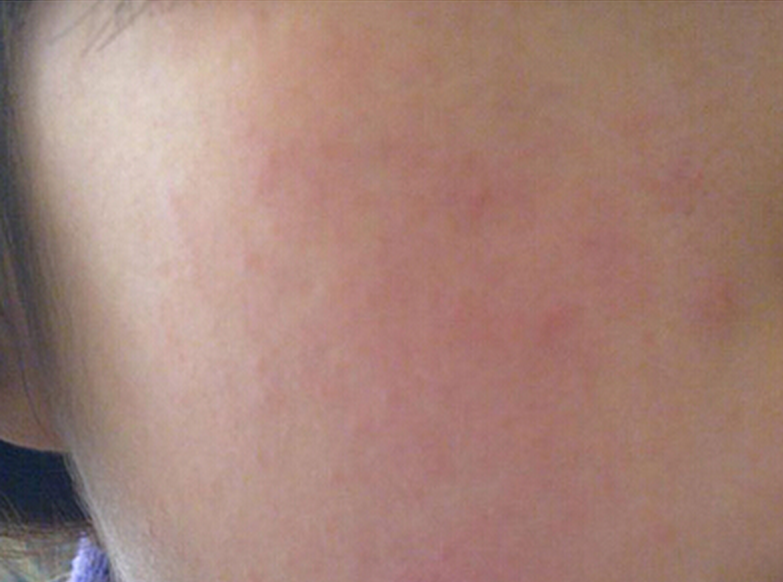 臉部夏季皮炎症狀 