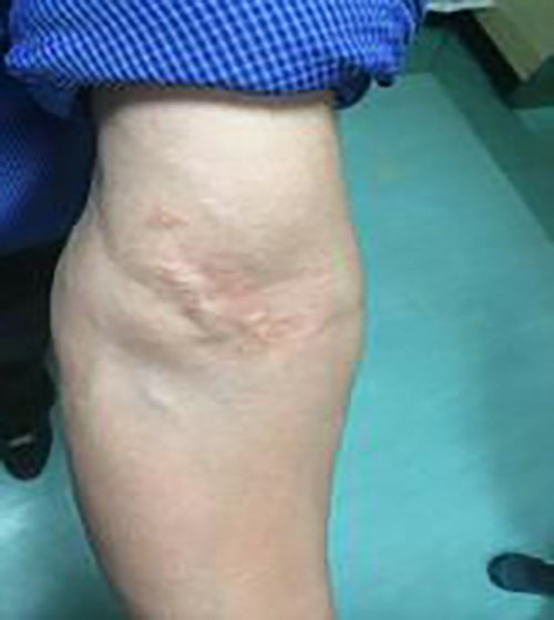 肘關節滑膜肉瘤