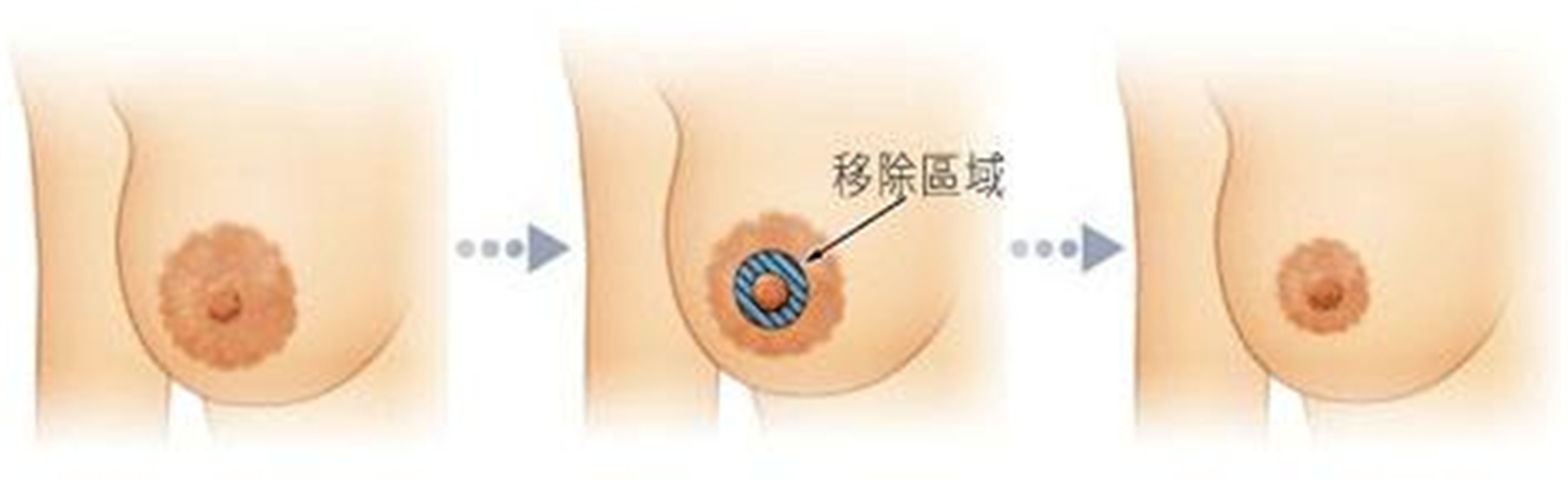 乳頭內陷的