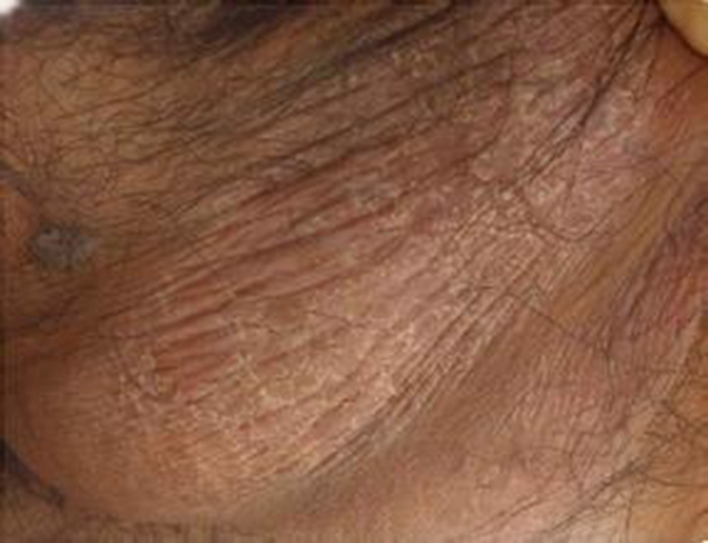 男外陰瘙癢的症狀