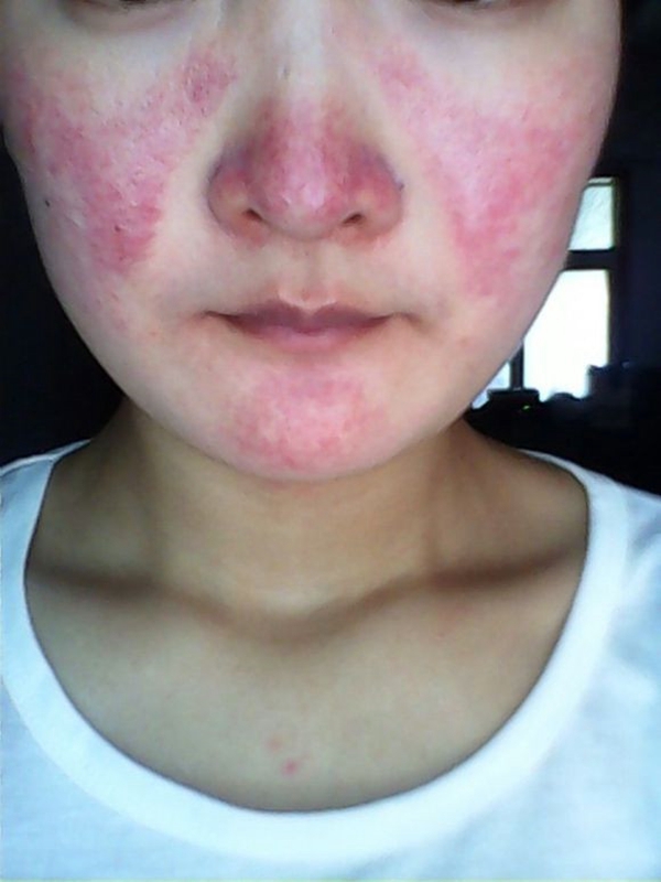 藥物性皮炎臉部