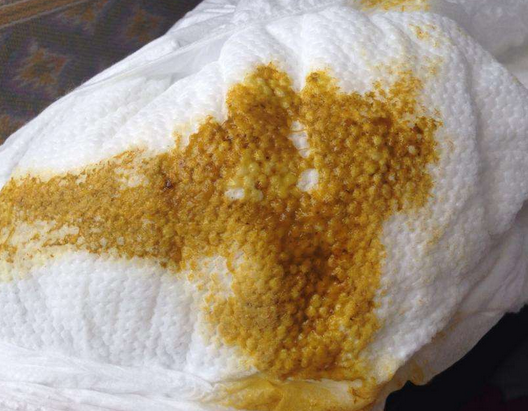 新生兒消化不良大便圖 (66) 