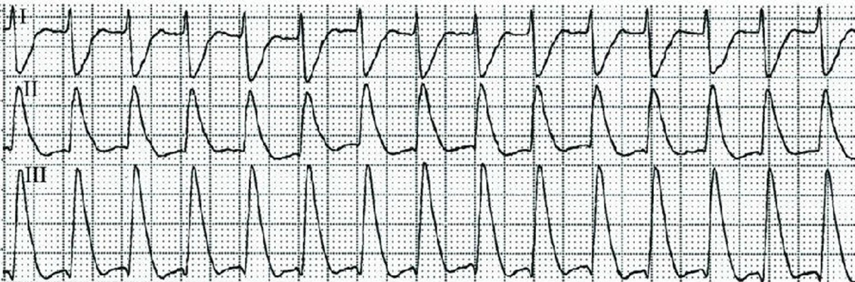 高鉀血癥心電圖 (55) 