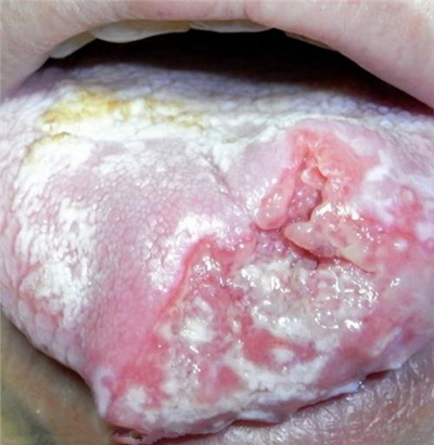 舌癌的初早期症狀