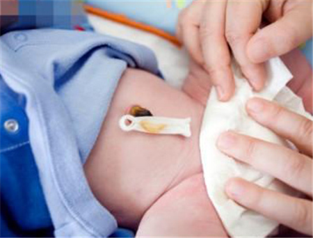 新生兒肚臍脫落圖 (51) 