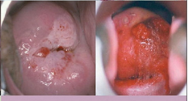 宮頸癌的早期症狀