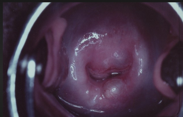 宮頸癌的早期症狀