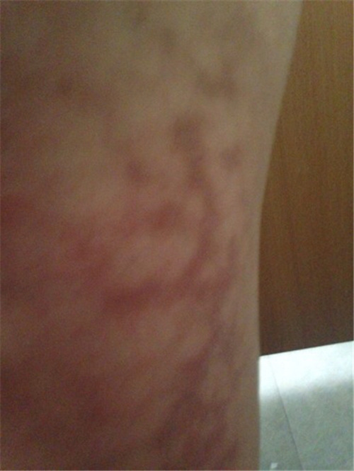 再生障礙性貧血早期症狀