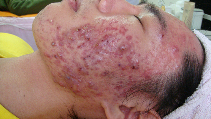 神經性皮炎的治療 (8) 