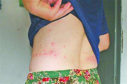 被跳蚤咬的症狀