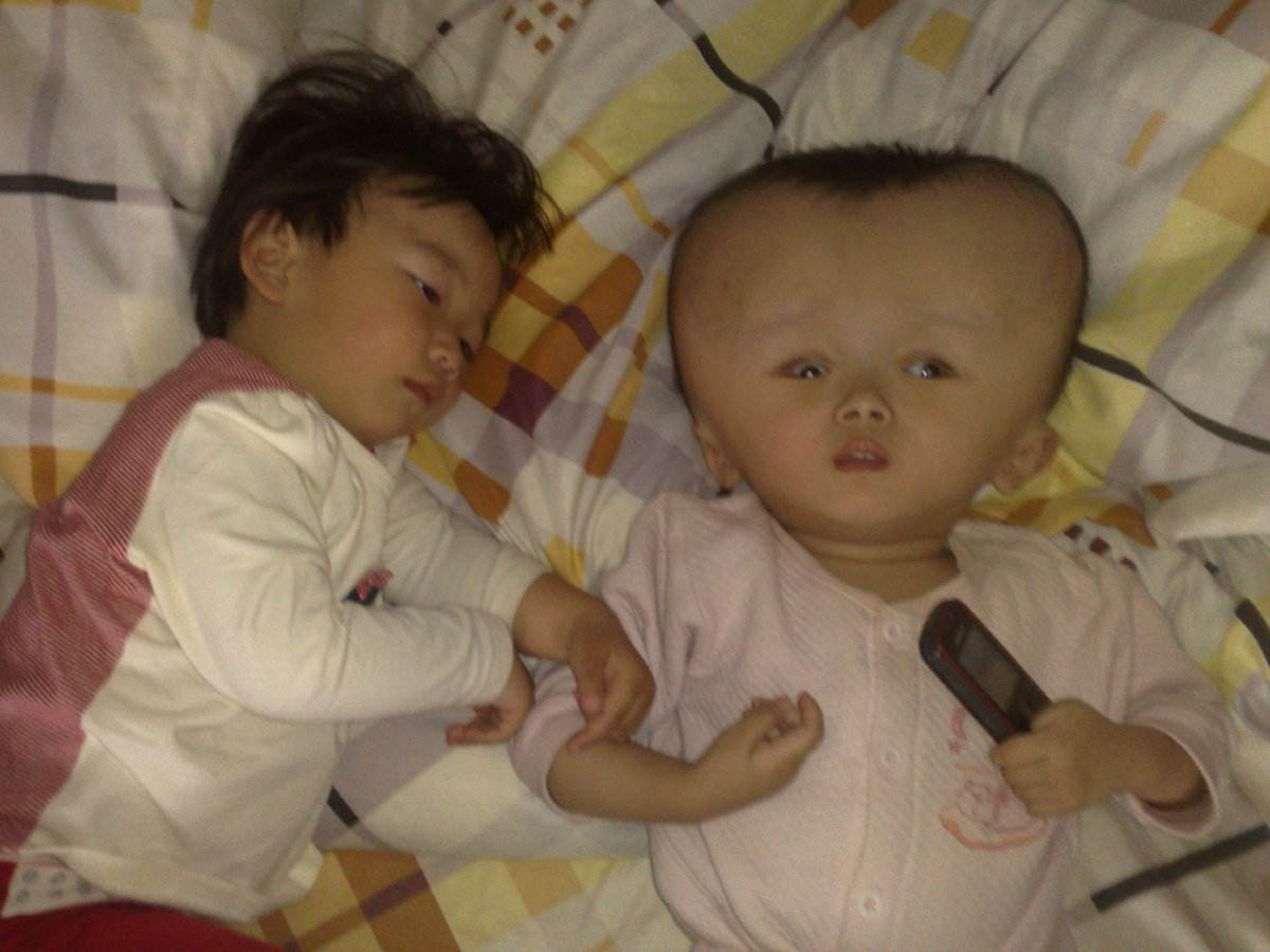 重度腦積水高清