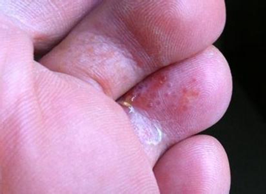 足蘚初期症狀