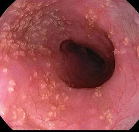 消化道白色念珠菌感染 