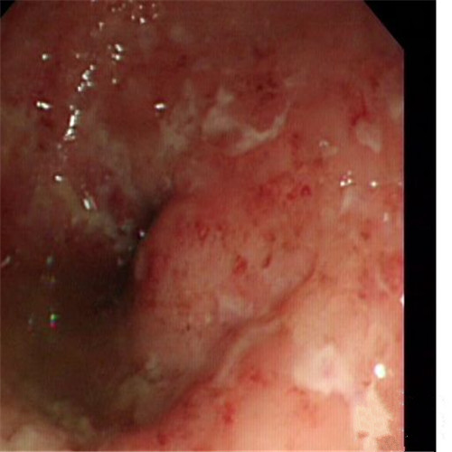 潰瘍性結腸炎水腫