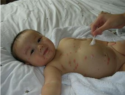 長水痘的症狀 (7) 