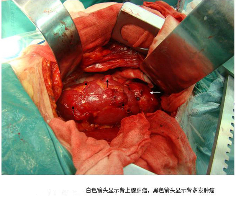 手術治療腎上腺腫瘤