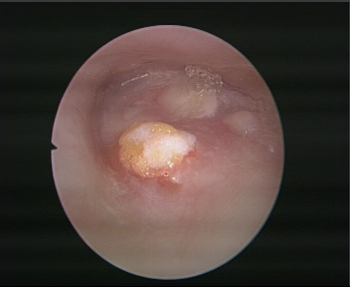 脂肪組織修補鼓膜穿孔