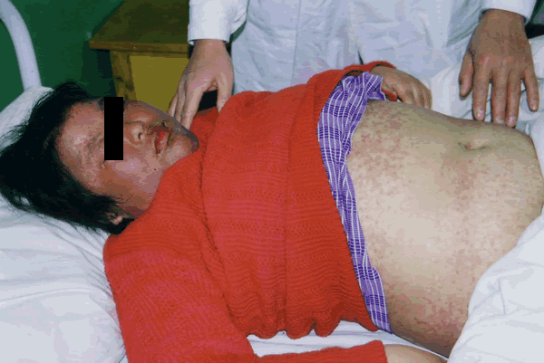 系統性紅斑狼瘡診斷標準 (6) 