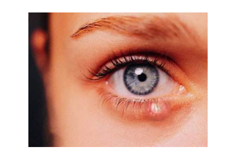 眼睛麥粒腫初期