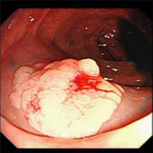 直腸息肉脫出的