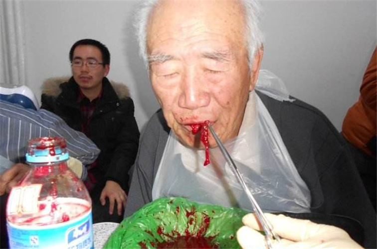 舌下放血取腦血栓