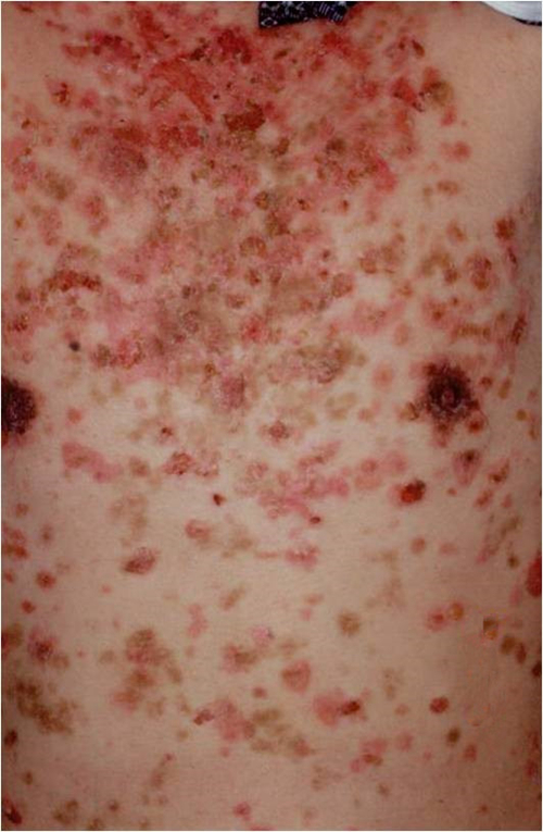 早期艾滋病大皰性皮膚病