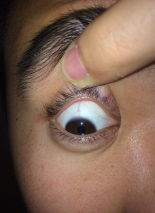 眼睛麥粒腫初期