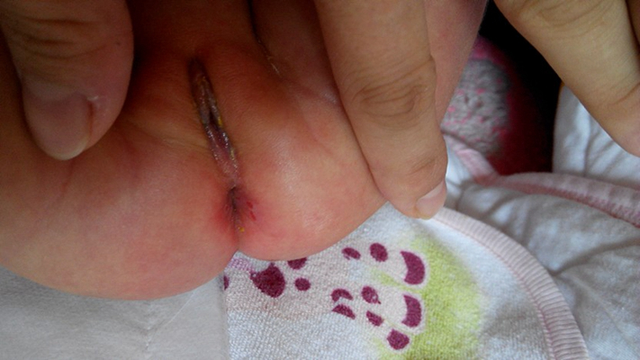 嬰兒肛周膿腫 (2) 
