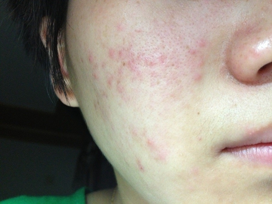 激素臉排毒症狀 (52) 