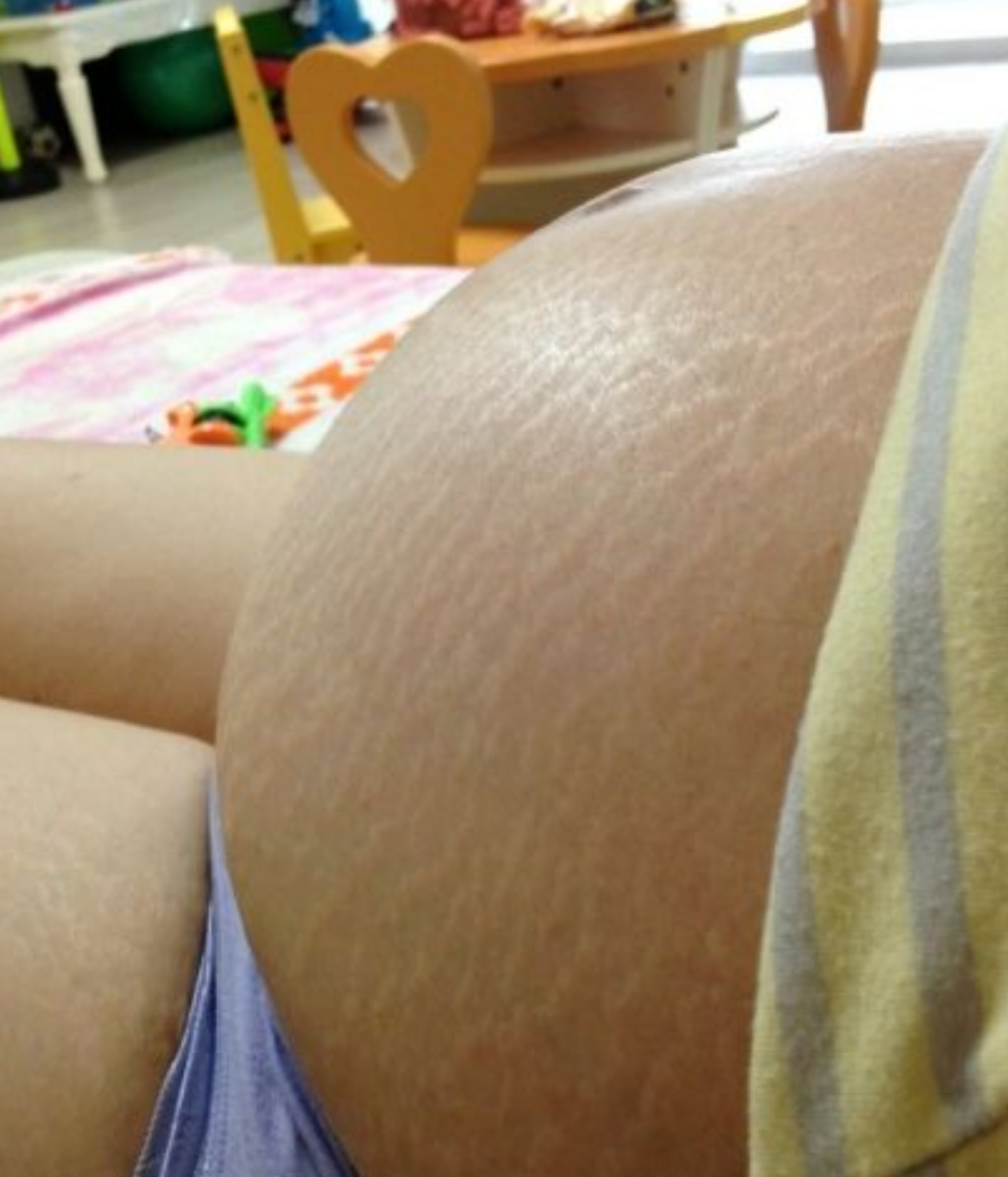 懷孕期妊辰紋女性