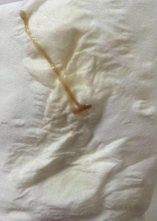 白帶帶有褐色分泌物 (64) 