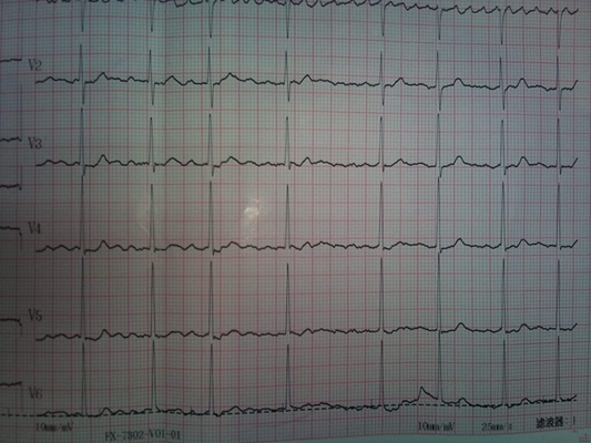 高鉀血癥心電圖 (7) 