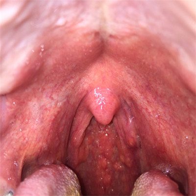 喉部淋巴濾泡增生 (36) 