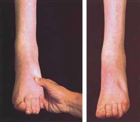 糖尿病腎病症狀