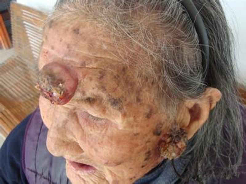 皮膚黃色瘤病凸起