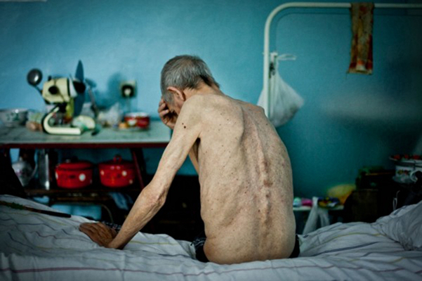 空洞型肺結核能活多久 (41) 