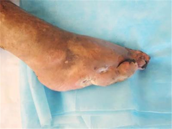 慢性骨髓炎治療