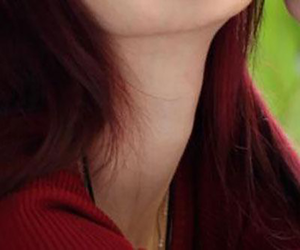 亞急甲狀腺炎症狀