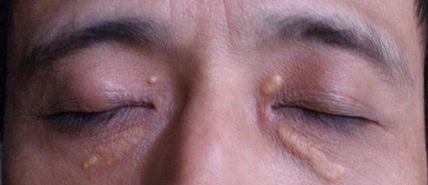 皮膚黃色瘤病臉部腫痛