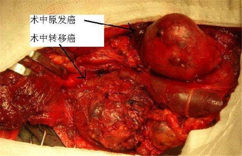 晚期甲狀腺癌手術