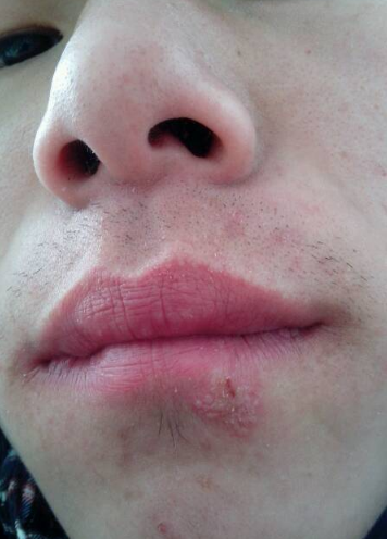 嘴唇潰瘍