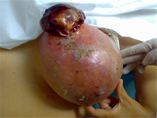 嚴重的乳腺纖維瘤