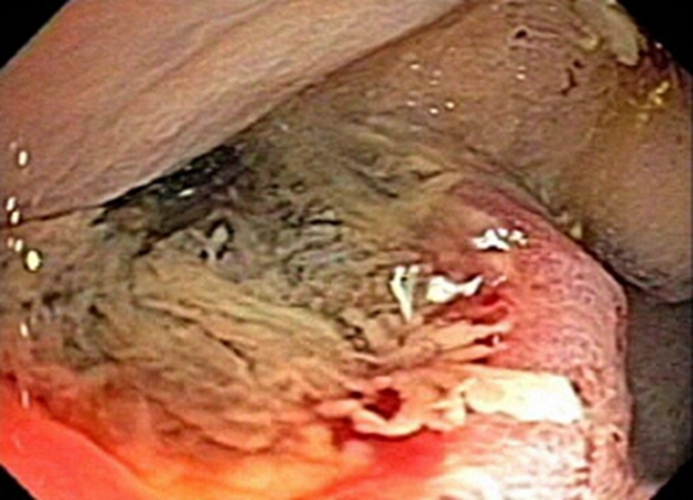 右半結腸癌的腺癌一級常見 臨床特點 