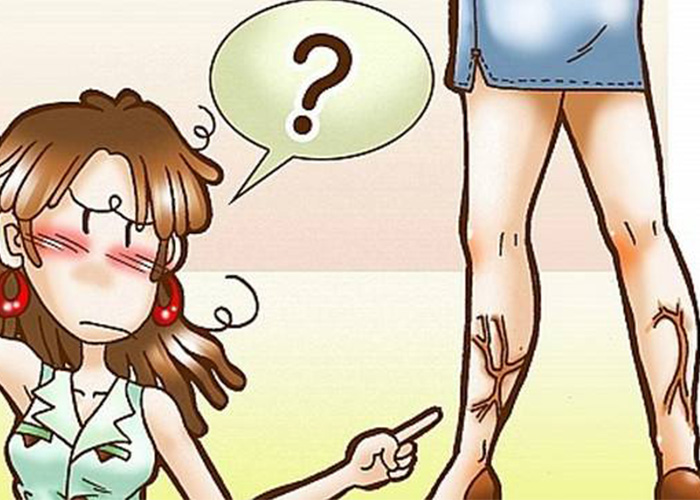 小腿靜脈曲張症狀漫畫 